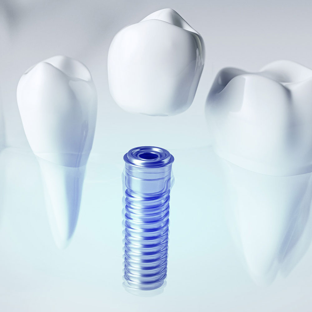Zubní implantáty