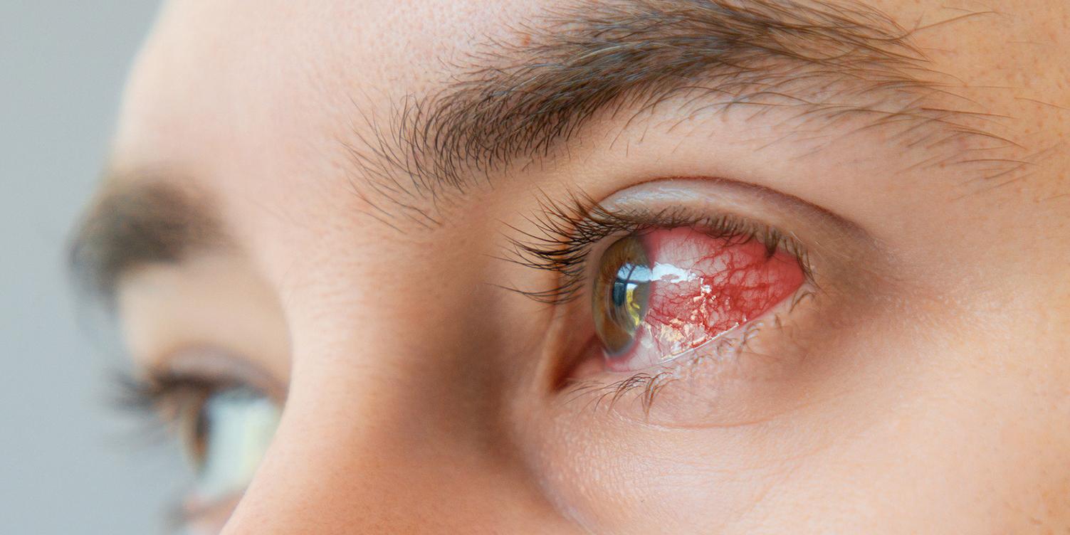 Close up of male brown bloodshot eyes and redness with vessels.
