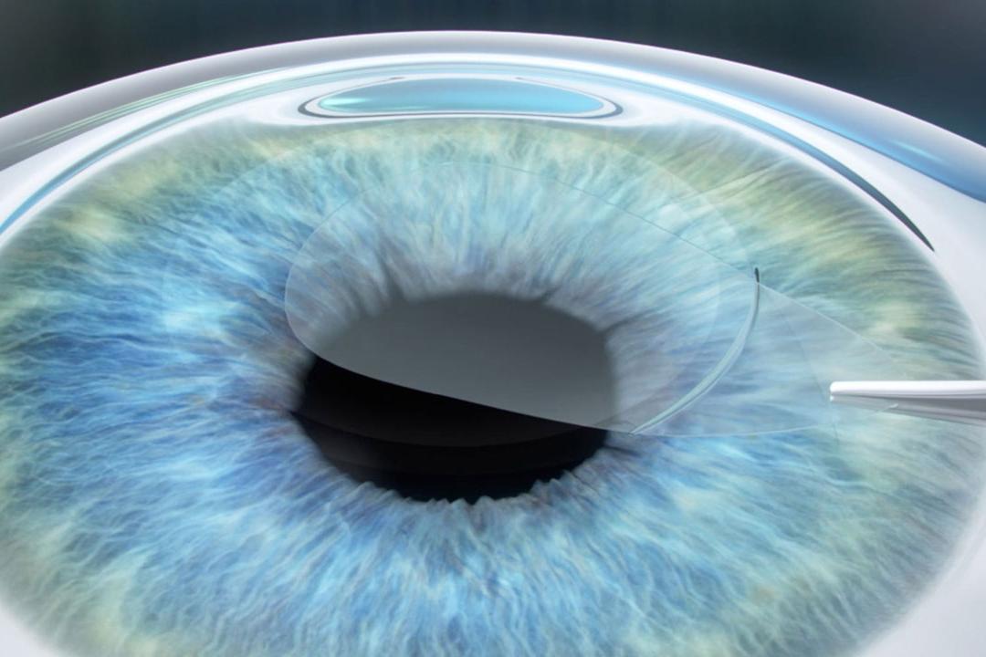 Nová léčebná metoda ReLEx™ smile vyvinutá v Carl Zeiss Meditec přináší revoluci do laserového léčení