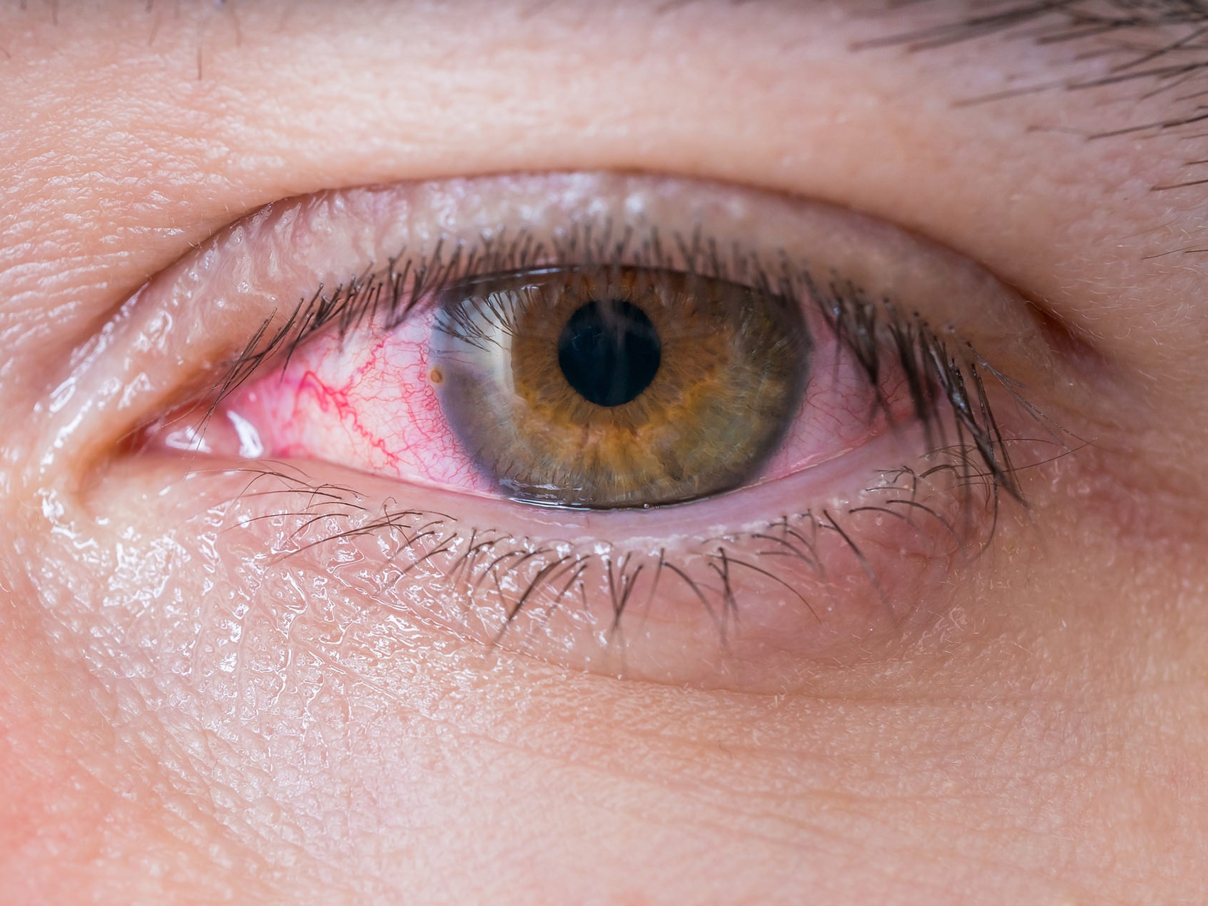 Pohled zblízka na nezdravé oko, který ilustruje vzhled možných rizik pro oči. 